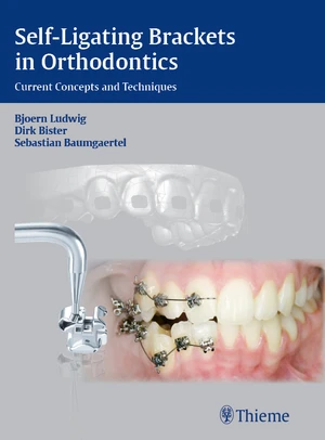 Self-ligating Brackets in Orthodontics