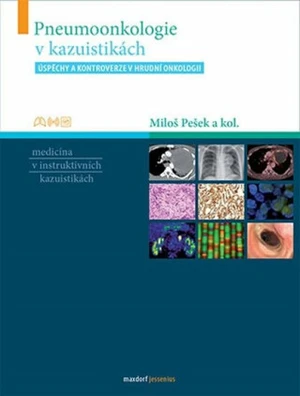 Pneumoonkologie v kazuistikách - Miloš Pešek