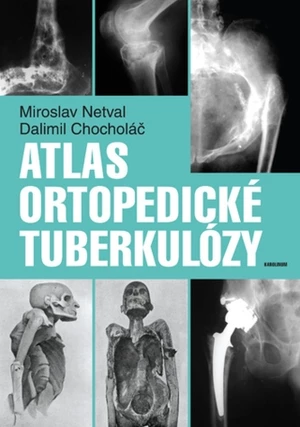 Atlas ortopedické tuberkulózy - Dalimil Chocholáč, Miroslav Netval - e-kniha
