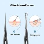 Blackhead Remover Cell Pimples Blackhead Clip Tweezers Removal Needle Beauty Salon Special Scraping Closing Acne Needle Tools