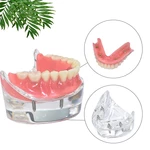 1Pcs Dental Teeth Model Removable Overdenture Lower Jaw 4 Implants M6003 Dentist Teaching Demonstration Model